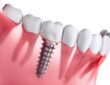 Considering Dental Implants