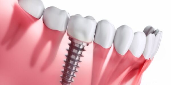 Considering Dental Implants