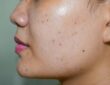 dark spots