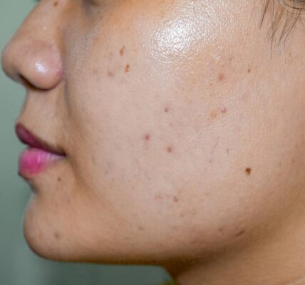 dark spots