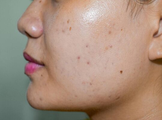 dark spots