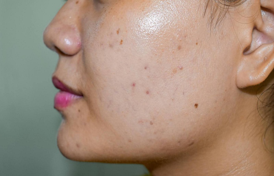 dark spots
